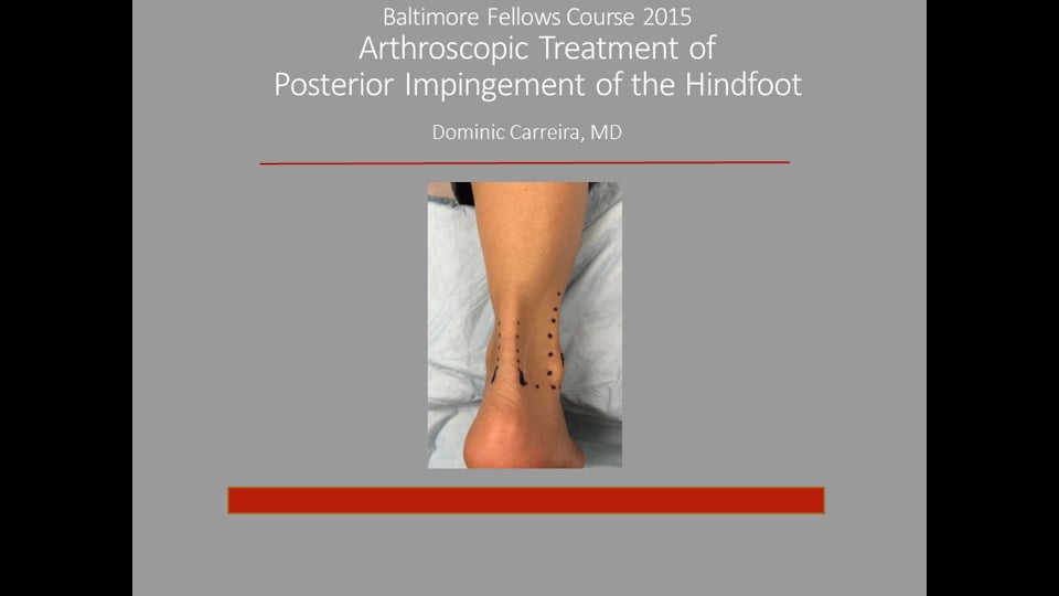 Baltimore Fellows Course 2015: Arthroscopic Treatment of Posterior Impingement of the Hindfoot
