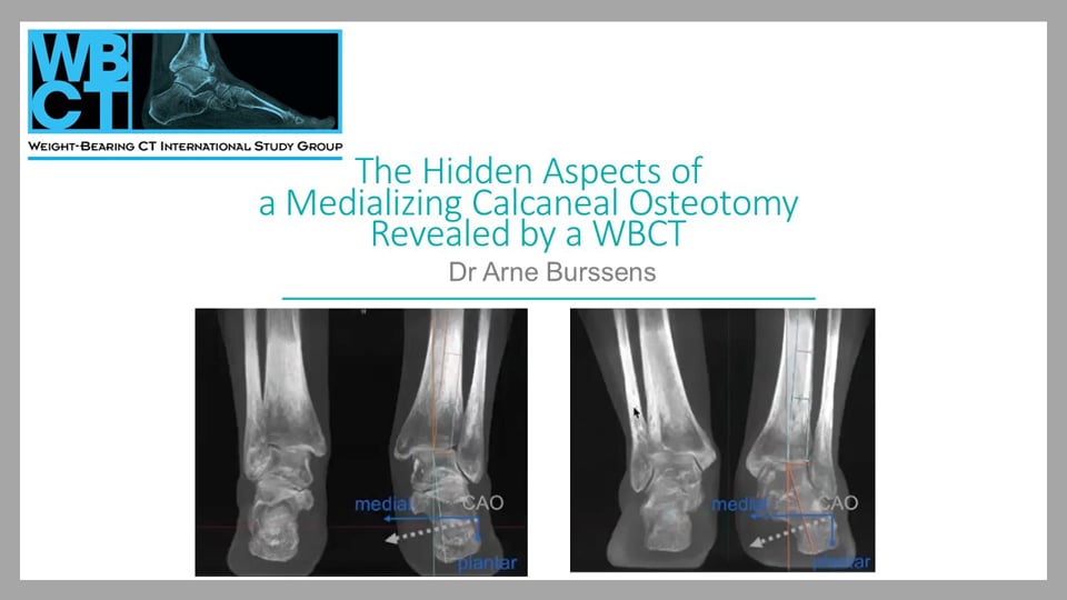 Int. WBCT Society Webcast: The Hidden Aspects of a Medializing Calcaneal Osteotomy Revealed by a WBCT