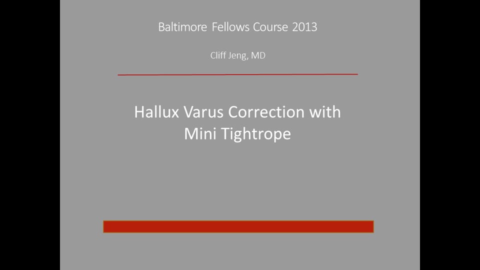 Baltimore Fellows Course 2013: Hallux Varus Correction with Mini Tightrope -Cliff Jeng, MD