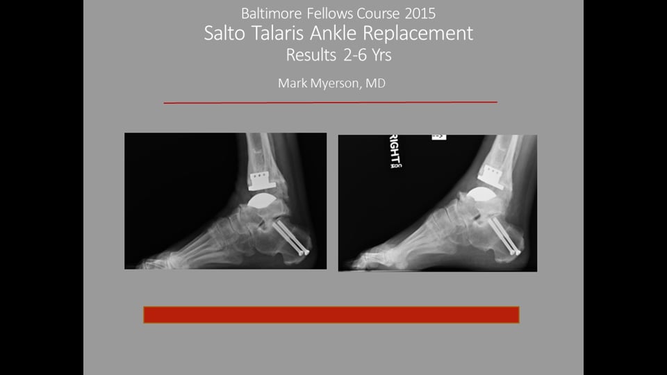 Baltimore Fellows Course 2015: Salto Talaris Ankle Replacement 2 -6 year Results