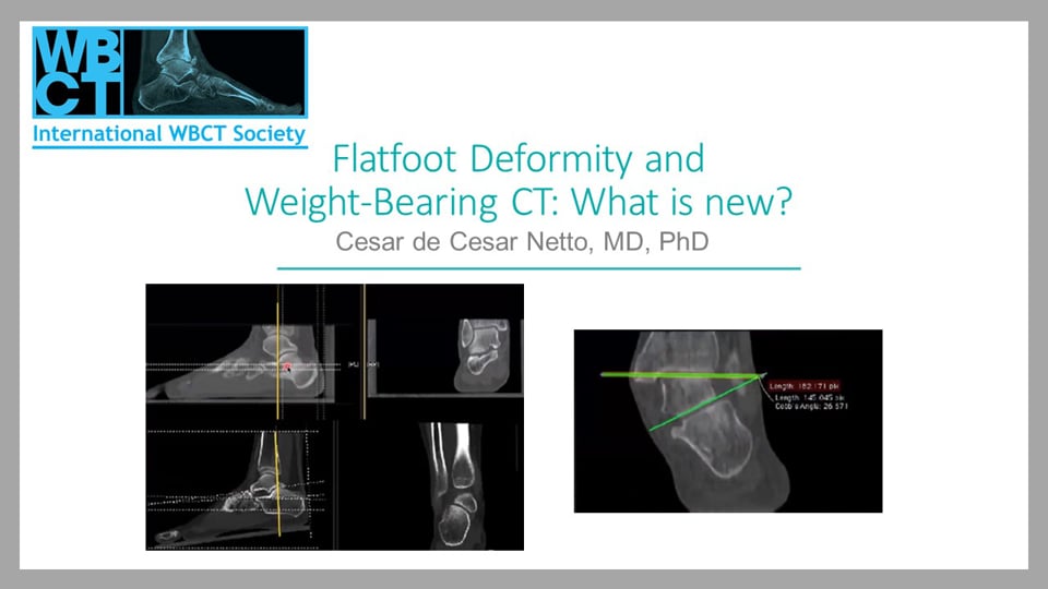 Int. WBCT Society Webcast: Flatfoot Deformity and Weight-bearing CT: What is new?