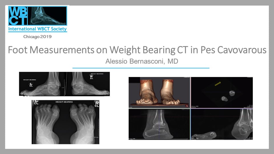 Int. WBCT Society 2019 Meeting: Foot Measurements on Weight Bearing CT in Pes Cavovarous