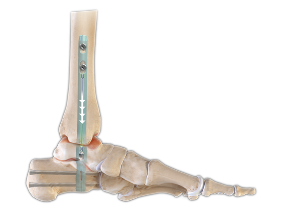 DualCompression Hindfoot Nail