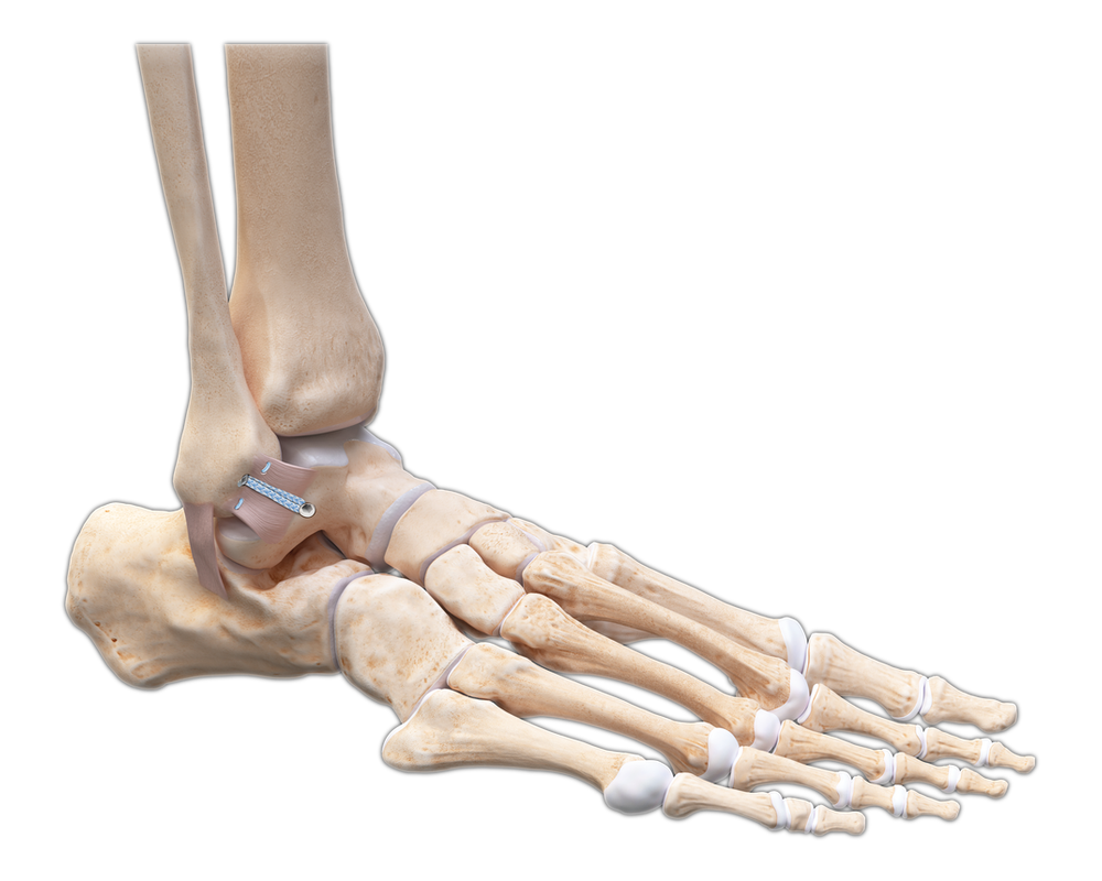InternalBrace Ligament Augmentation Repair