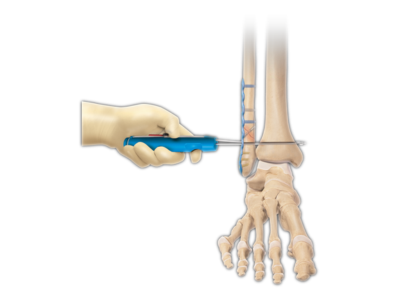Syndesmosis TightRope XP Implant System