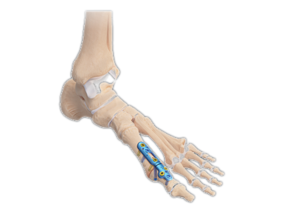 MaxForce MTP Fusion Plating System