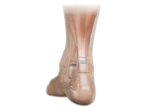 PARS Achilles Midsubstance SpeedBridge Repair