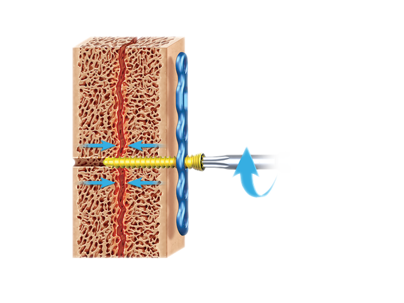 KreuLock Locking Compression Screws
