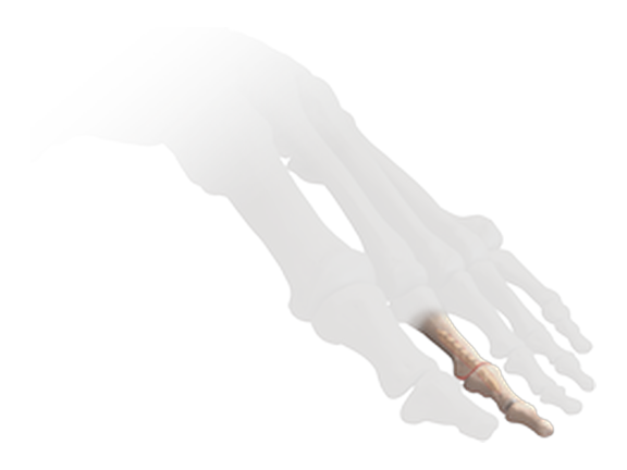 PIP Hammertoe Implant