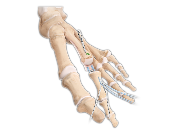 Plantar Plate Repair