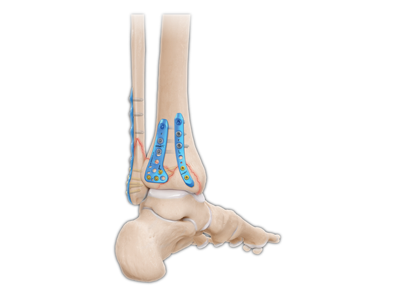 Ankle Fracture Plating System