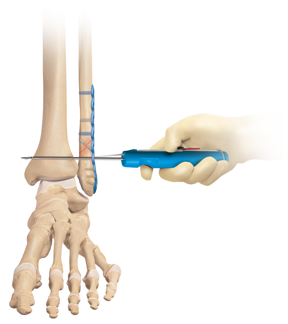 Syndesmosis TightRope XP Implant System